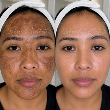 COSMELAN PEEL