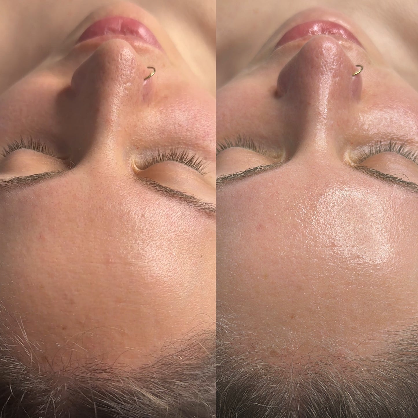 CO₂ carboxy THERAPY