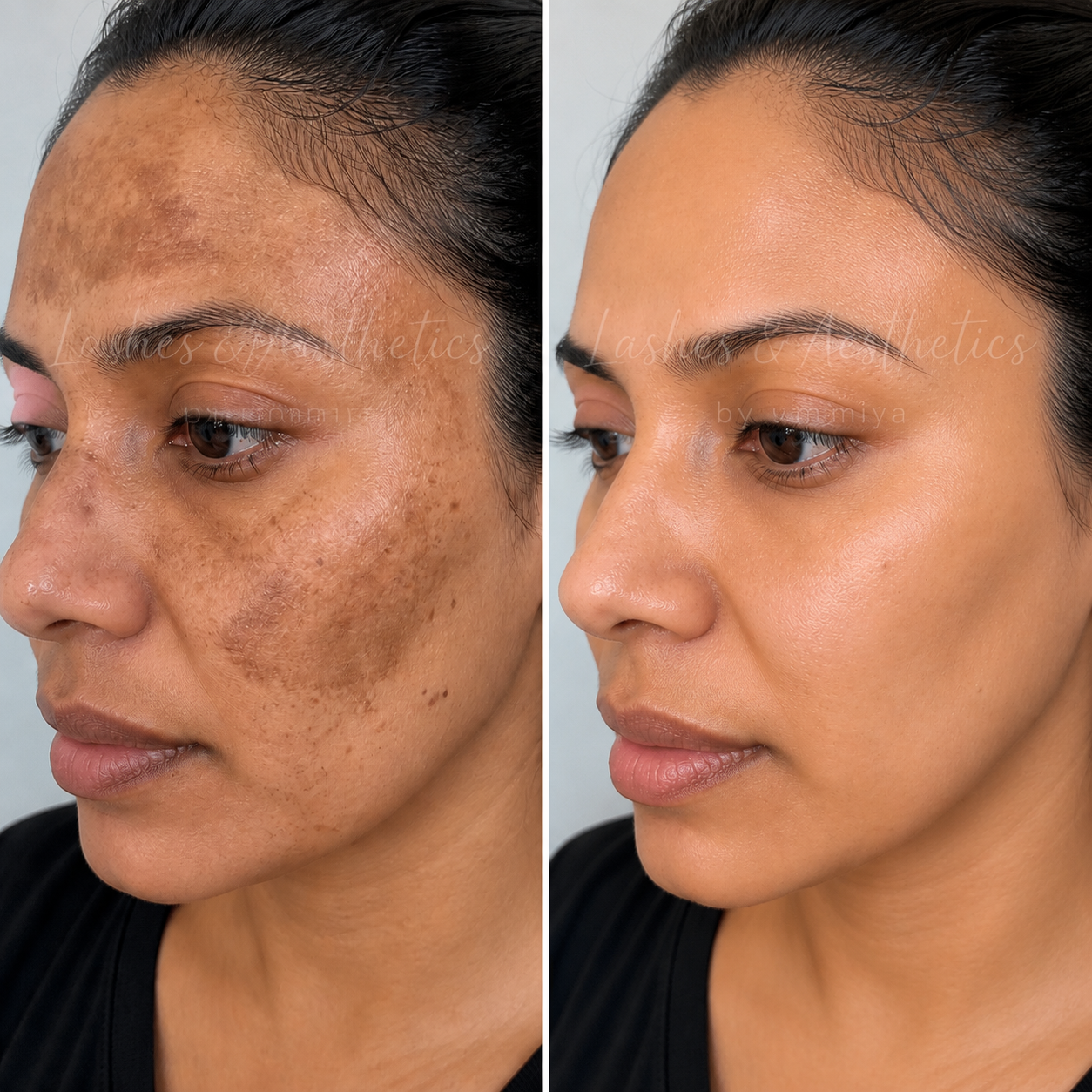 COSMELAN PEEL