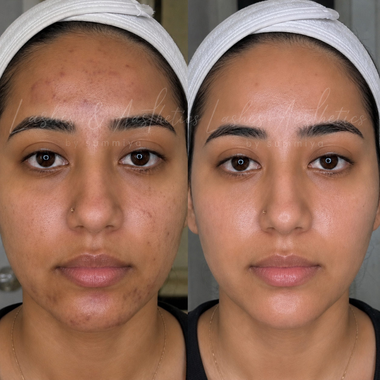 COSMELAN PEEL