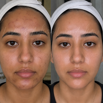 COSMELAN PEEL