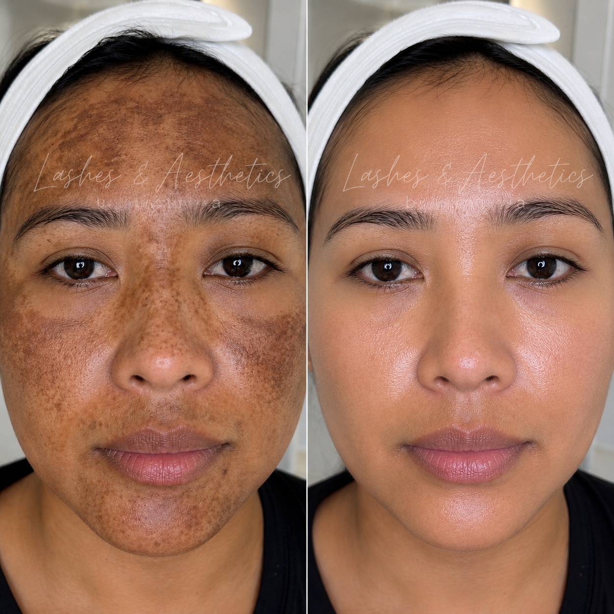 COSMELAN PEEL