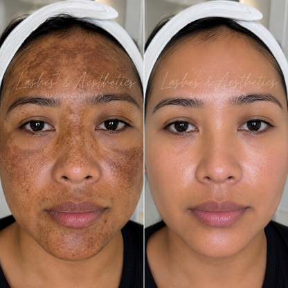 COSMELAN PEEL