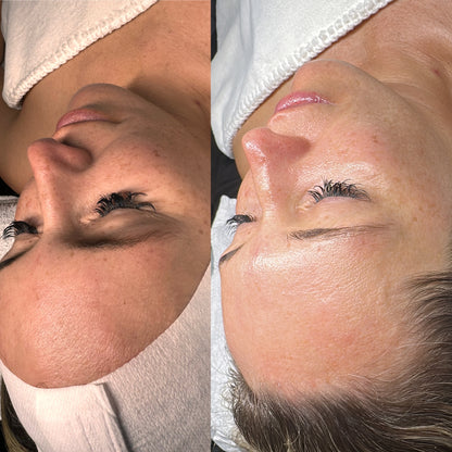 CO₂ carboxy THERAPY