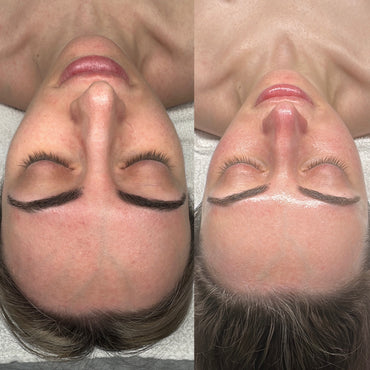 CO₂ carboxy THERAPY