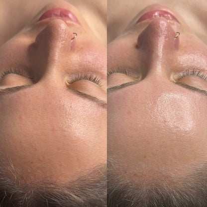 CO₂ carboxy THERAPY