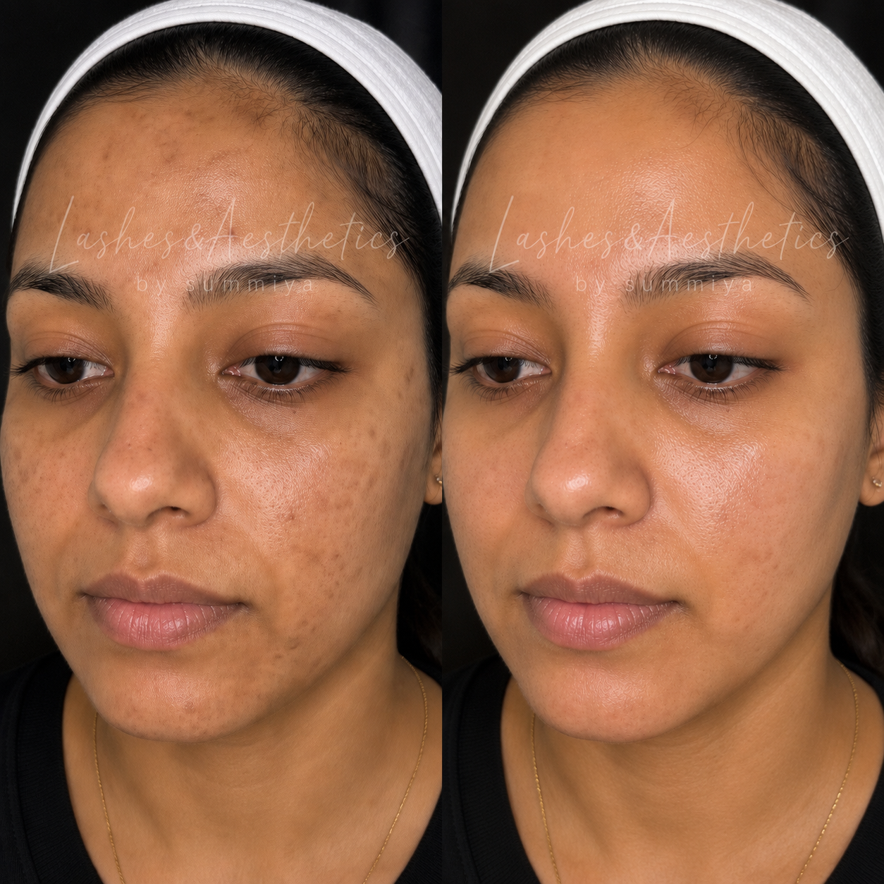 COSMELAN PEEL