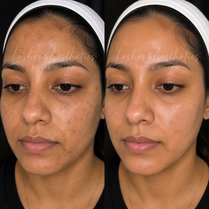 COSMELAN PEEL