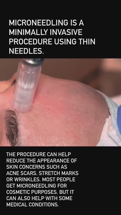 Microneedling
